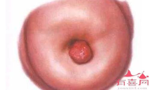 威海助孕中介高端群-子宫颈口的一个小肉球有什么问题？